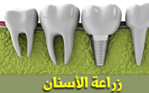 تكلفة-زراعة-الاسنان-في-تونس