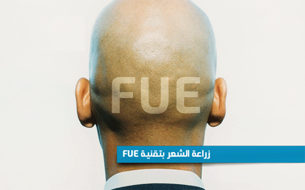 زراعة-الشعر-بتقنية-FUE-تونس