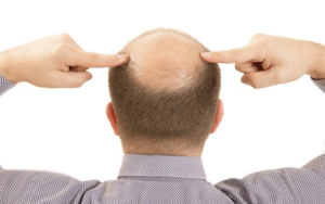 علاج-سقوط-الشعر-للرجال