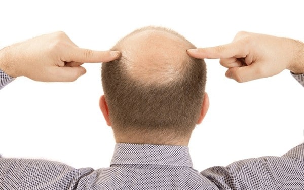 علاج سقوط الشعر للرجال