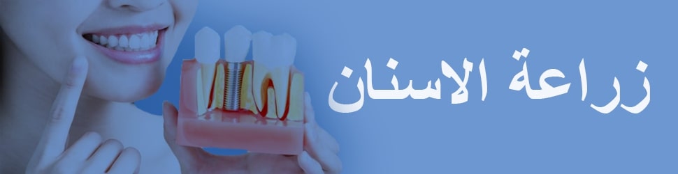 زراعة الاسنان