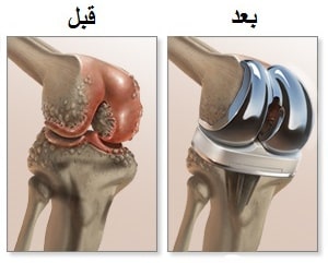 قبل بعد تبديل الركبة