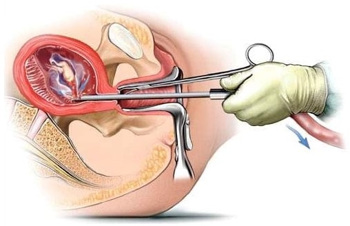 الاجهاض الجراحي