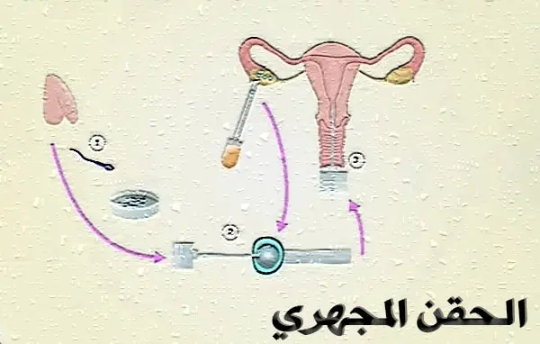 الحقن المجهري